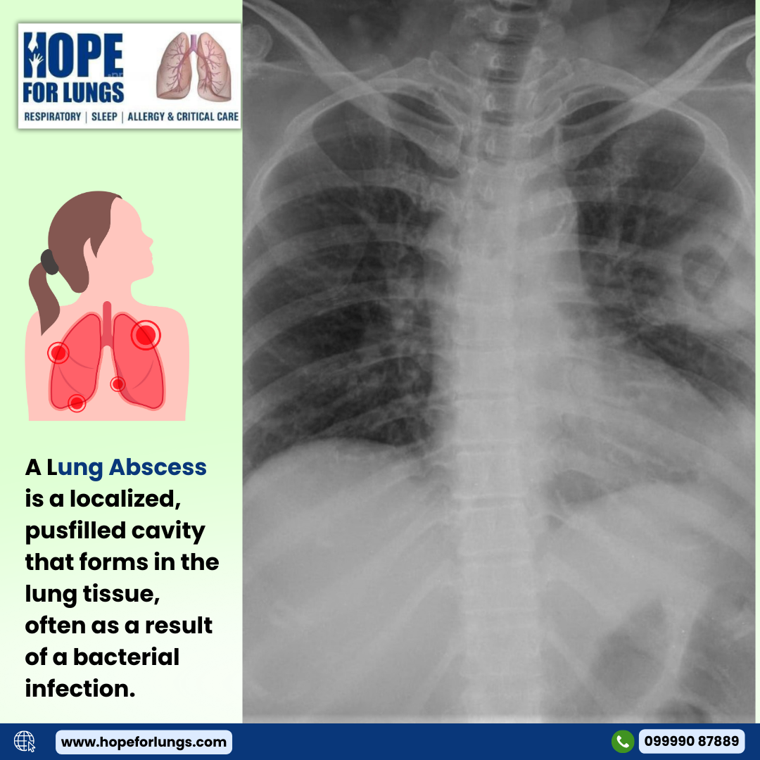 Lung Abscess